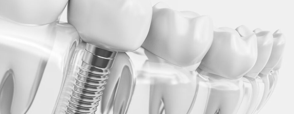 Dental Implants — Specialist Level,