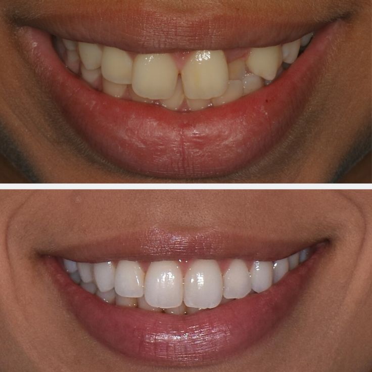 before after teeth straightening
