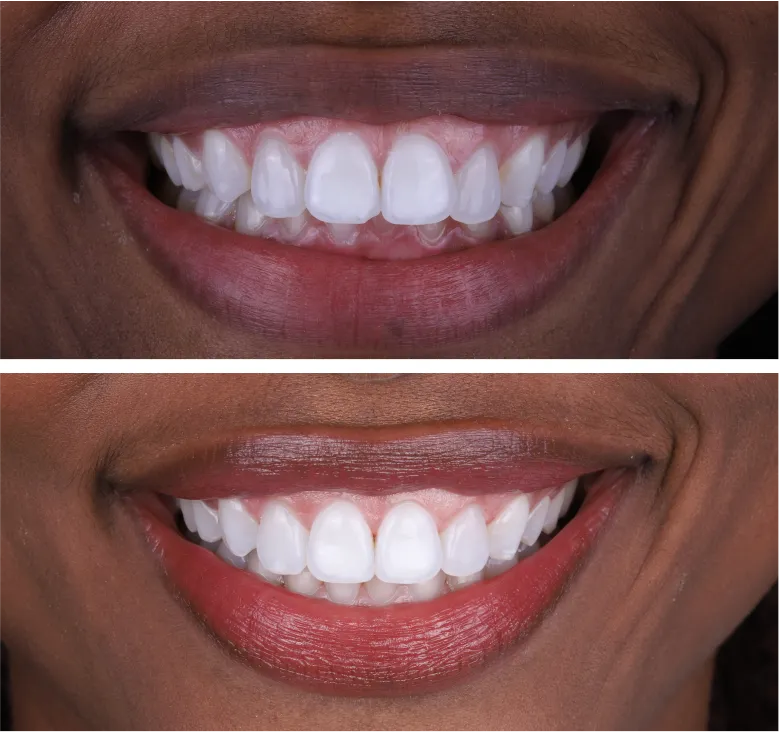 before after teeth straightening