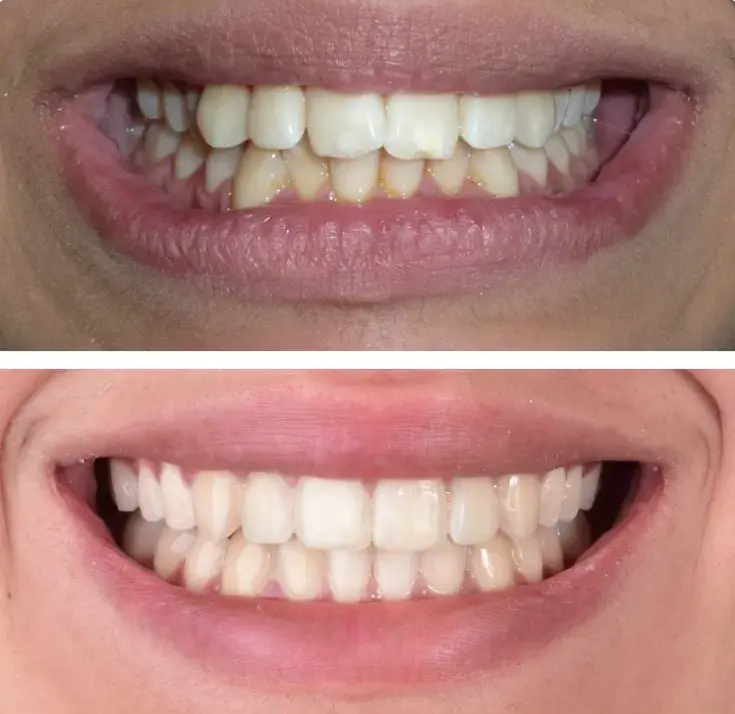before after teeth straightening